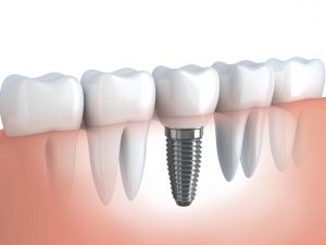 Importance and Benefits of Dental Implants